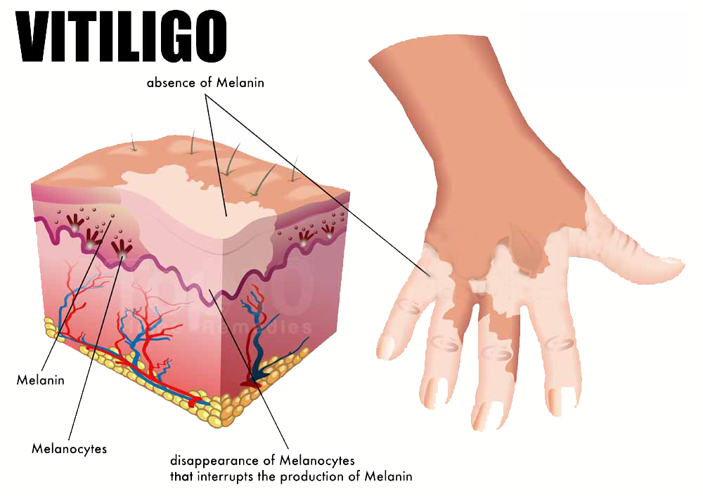 7 Natural Home Remedies For Vitiligo - No Miracle