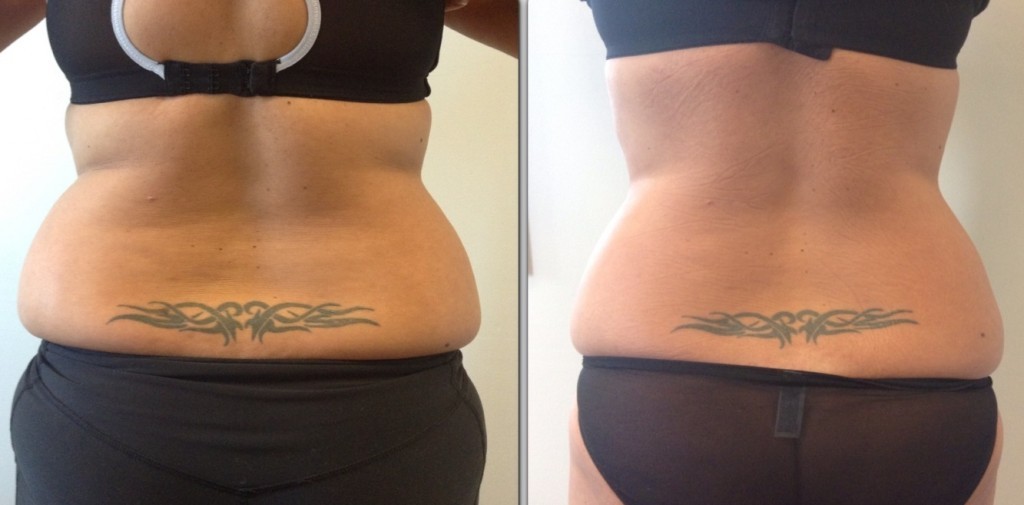 Permanently Getting Rid Of Unwanted Fat Through 3D Liposuction