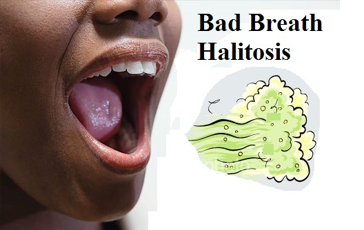 What Is Halitosis?