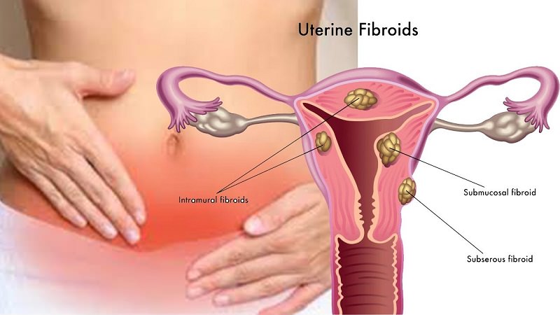 Uterine fibroids – Symptoms, Causes & Cure: